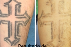 Borrado de tatuajes en Madrid